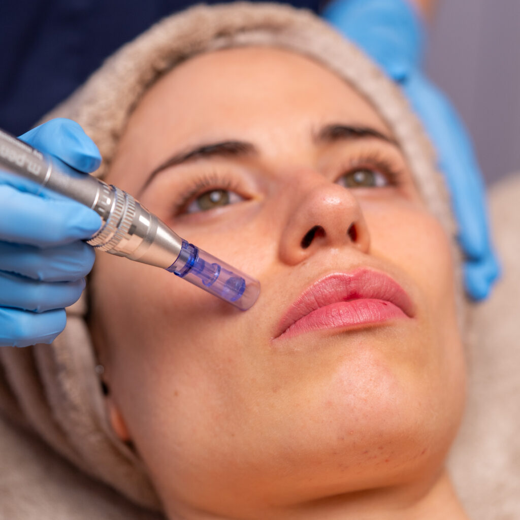 Microneedling facial con Dermapen para rejuvenecimiento y mejora de la textura de la piel en Barcelona
