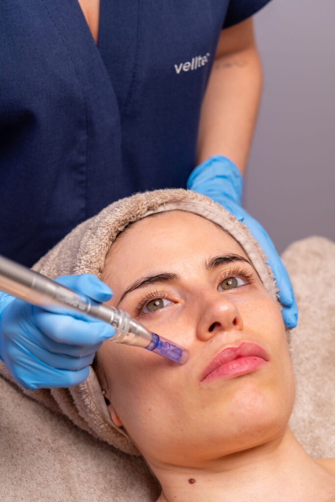 Tratamiento facial micronnedling con exosomas